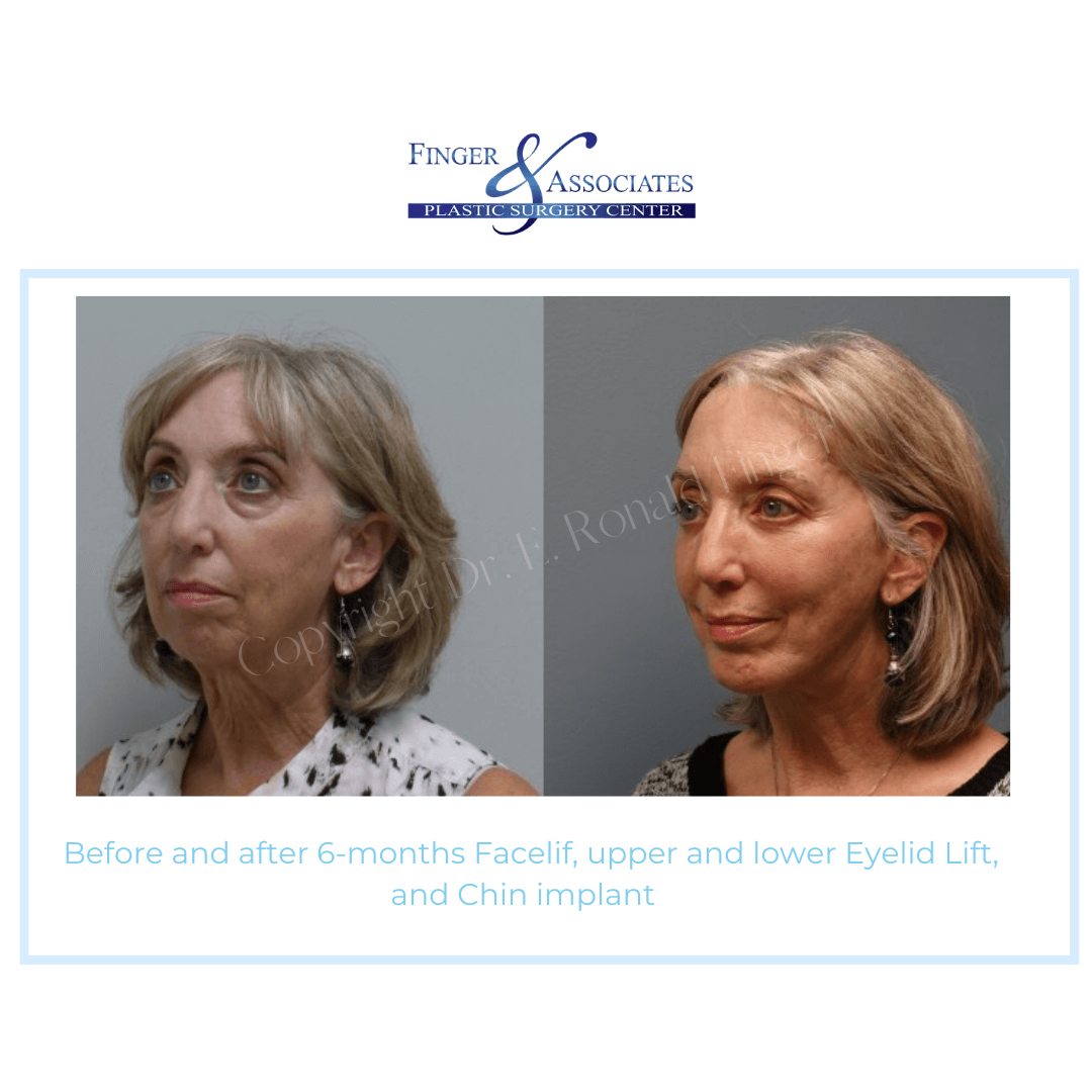 Before and After 6-months Facelift, Upper and Lower Eyelid Lift, and Chin Implant