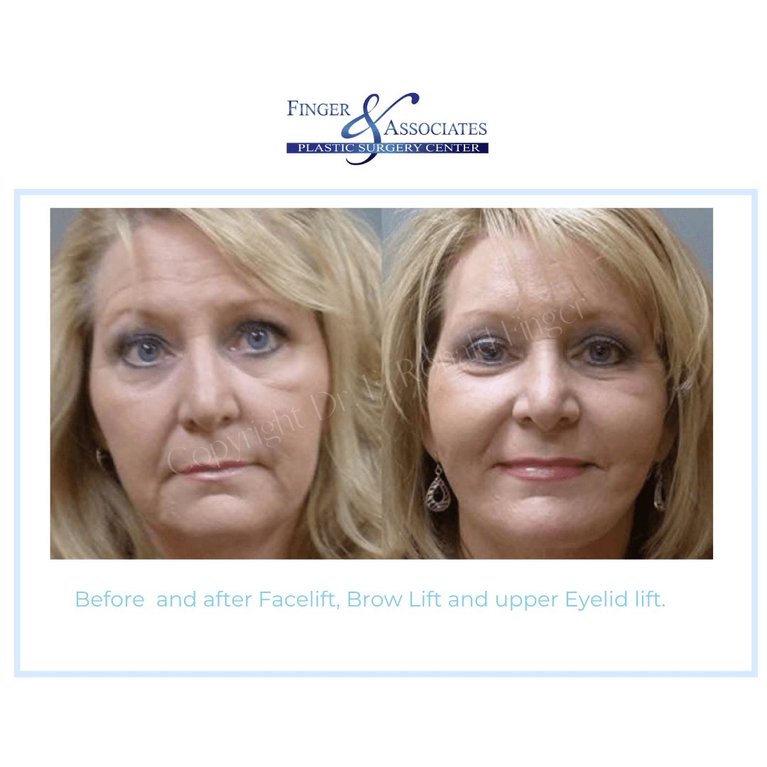 Before and After Facelift, Brow Lift and Upper Eyelid Lift Before and After Facelift, Brow Lift and Upper Eyelid Lift