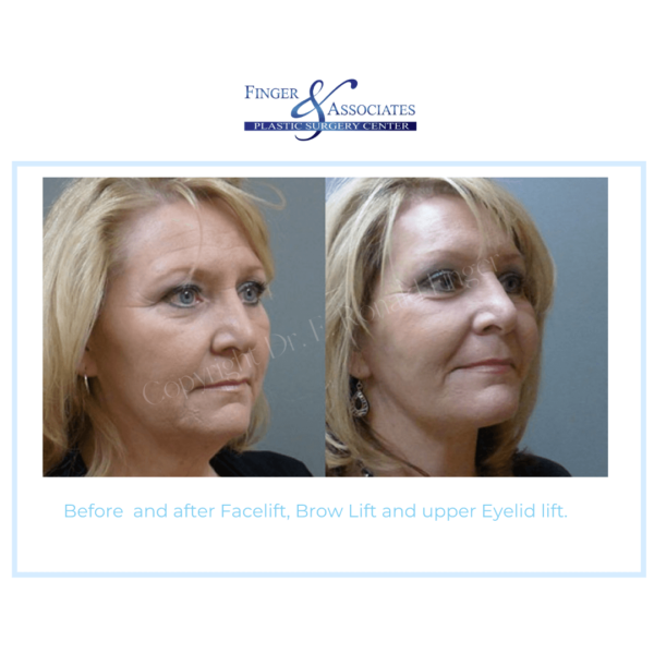 Before and After Facelift, Brow Lift and Upper Eyelid Lift