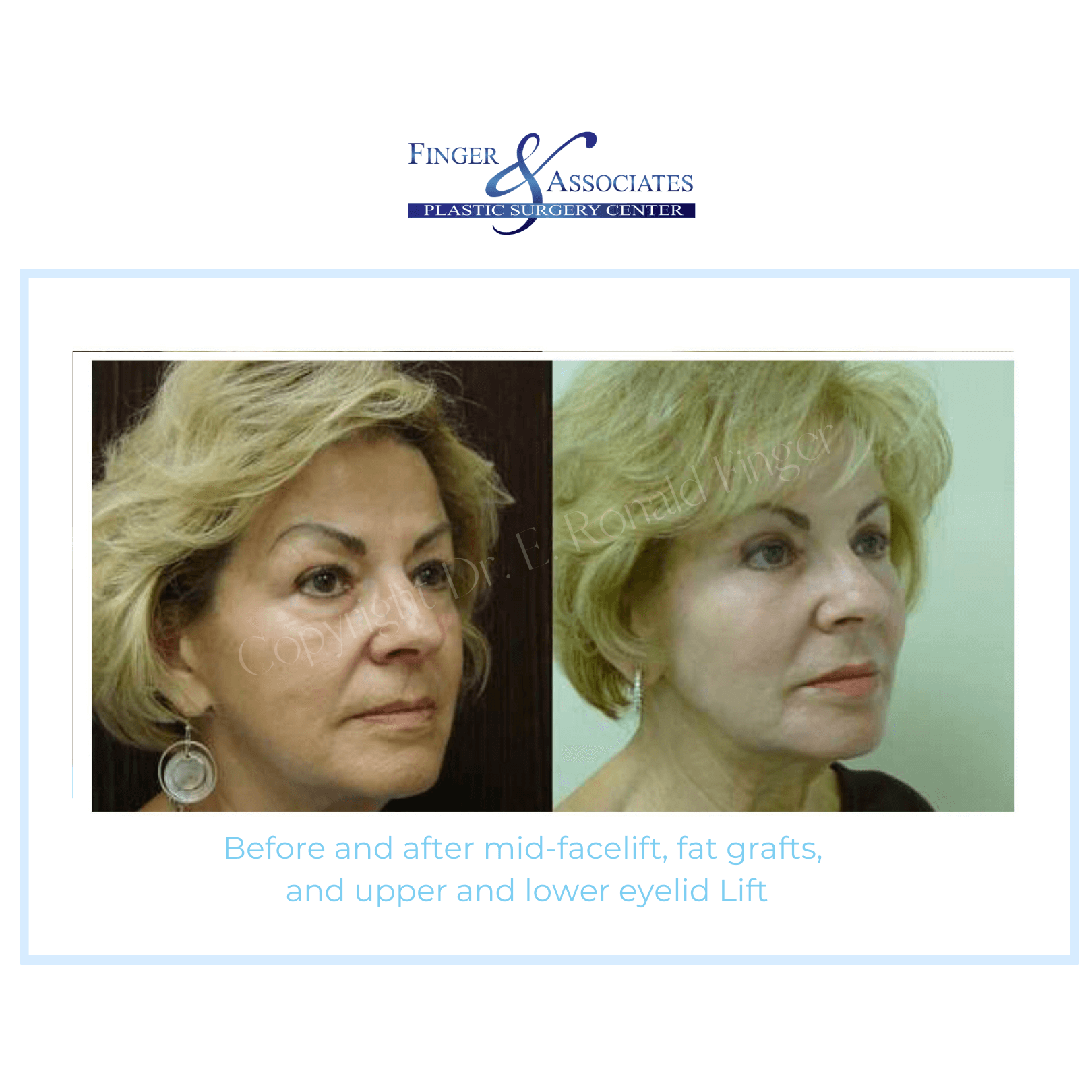 Before and after mid facelift and eyelid surgery