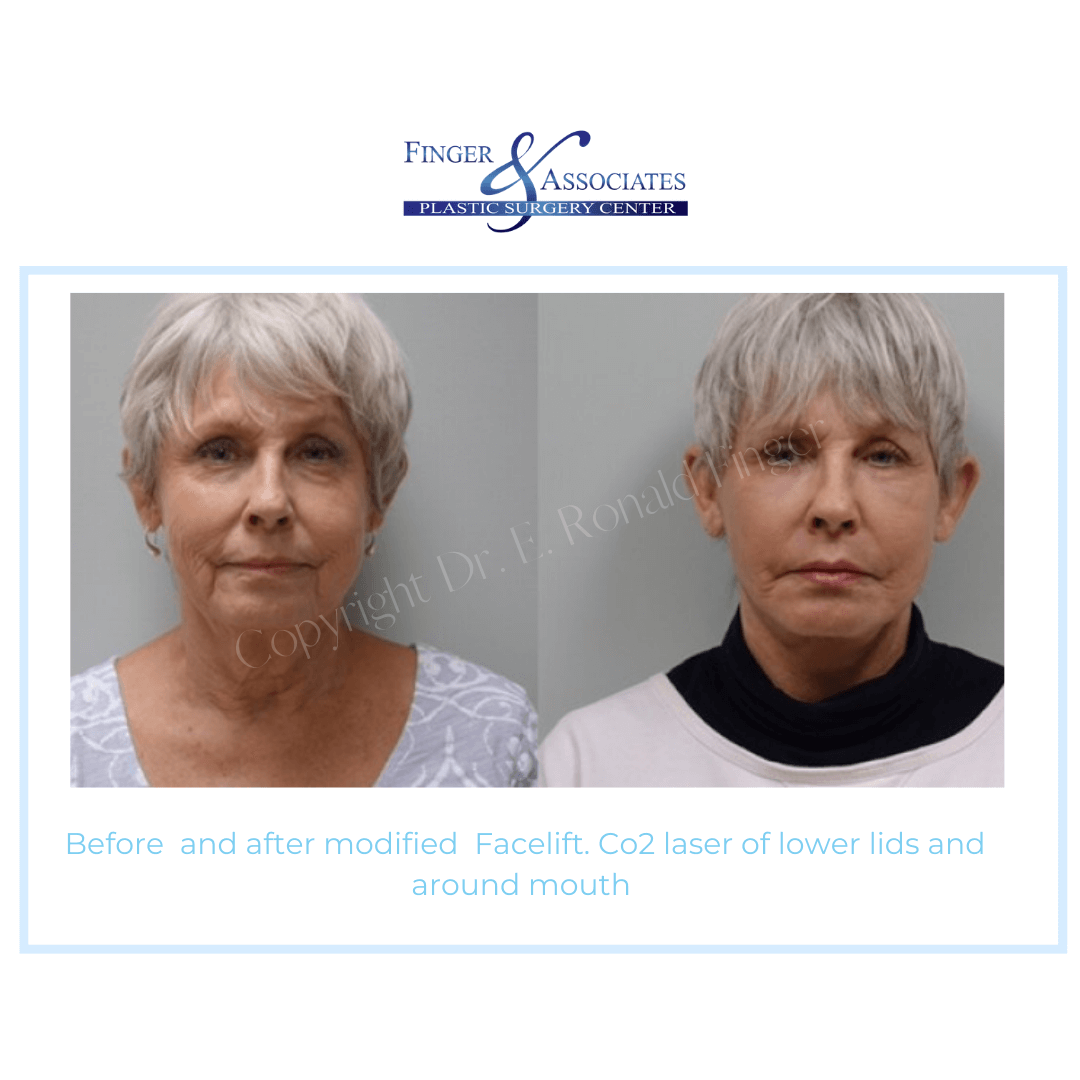 Before and After modified Facelift. Co2 Laser of lower lids and around mouth