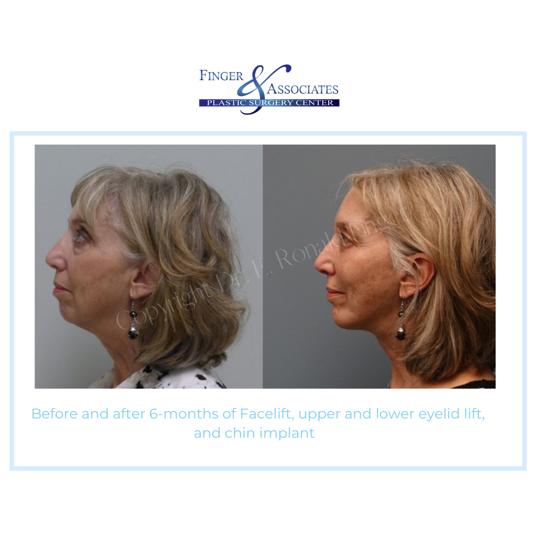 Before and after Facelift and chin implant