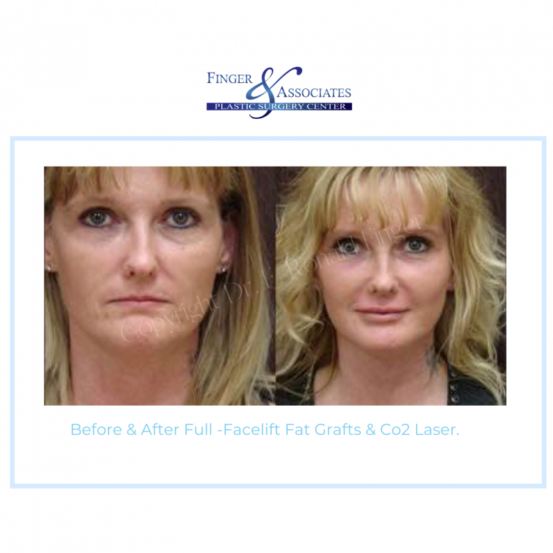 Before & After Full -Facelift Fat Grafts & Co2 Laser. 