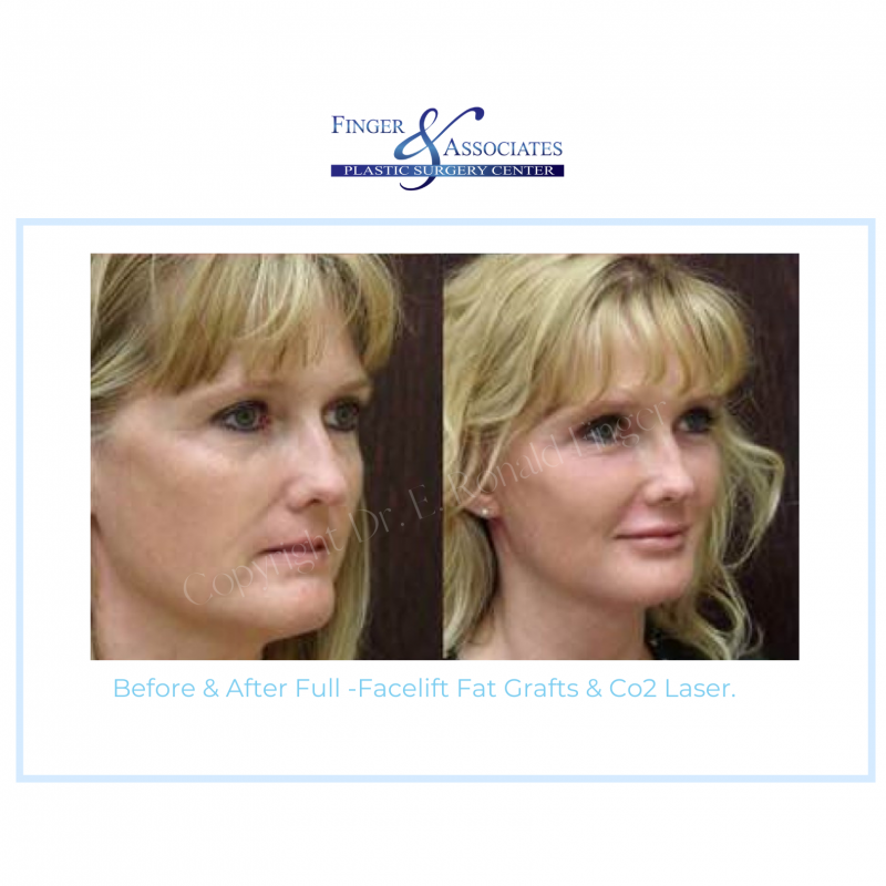 before and after facelift and eyelid lift