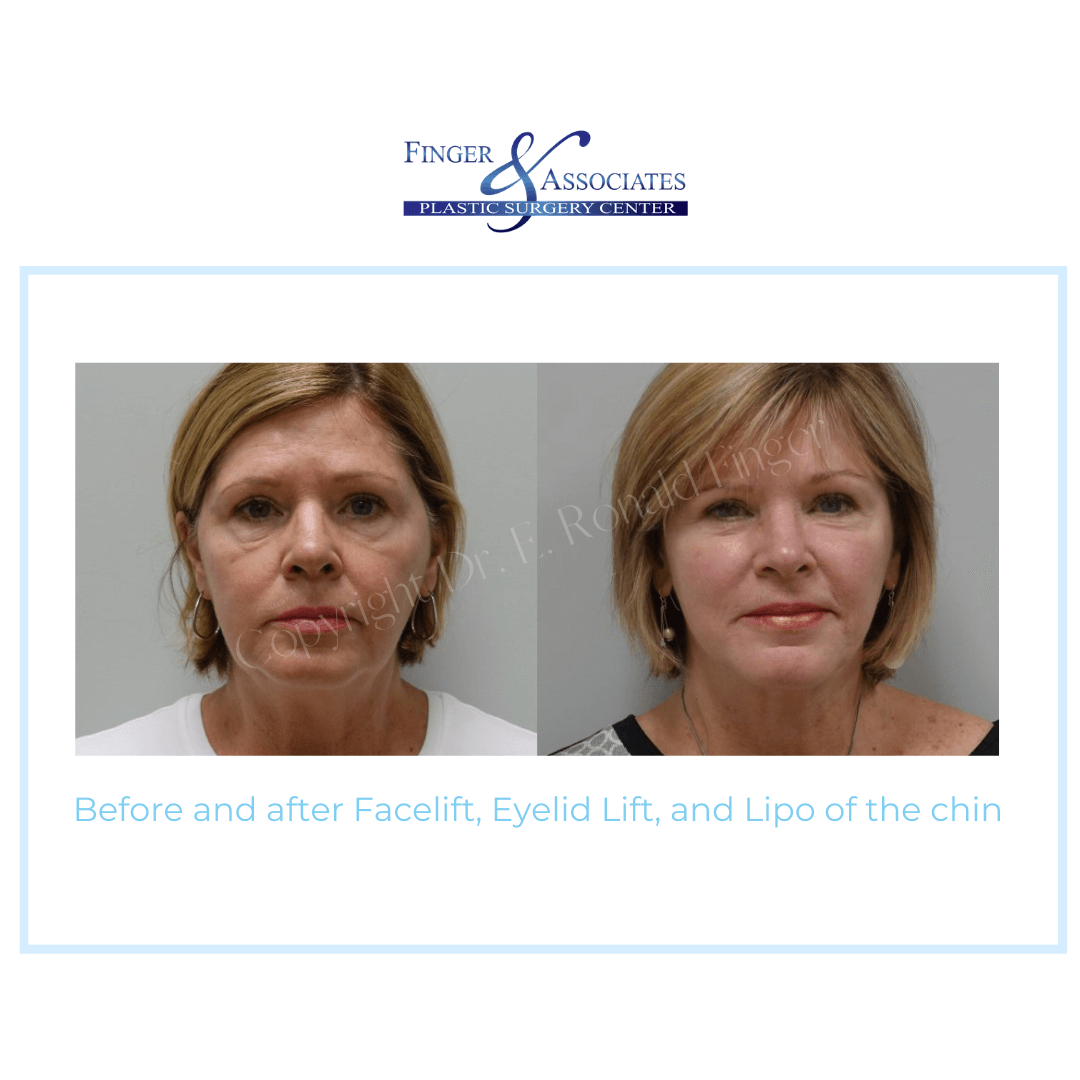 Before and AFter Facelift, Eyelid Lift and Lipo of the chin