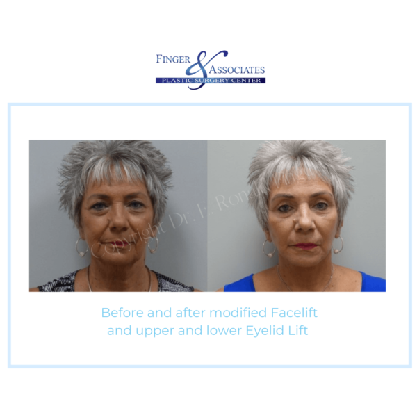 Before and After modified Facelift and upper and lower Eyelid Lift
