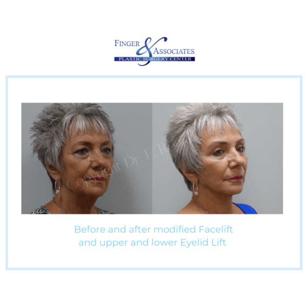 Before and After modified Facelift and Upper and Lower Eyelid Lift