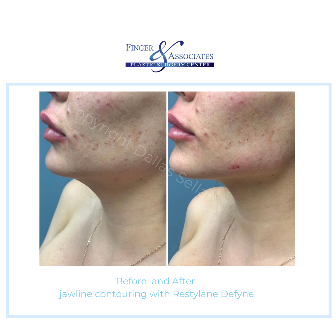 before and after Defyne jaw filler