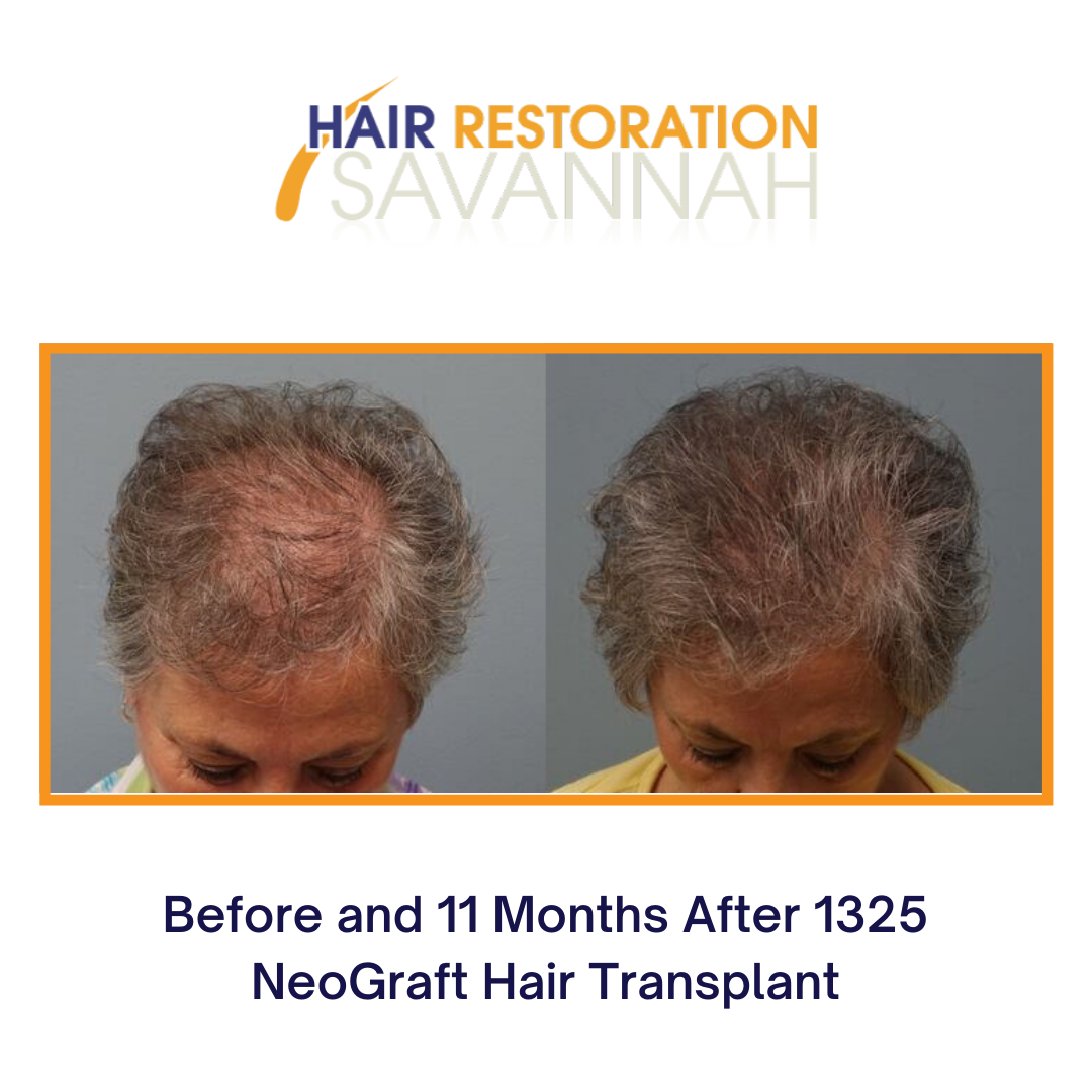 Before and after Neograft Hair Transplant