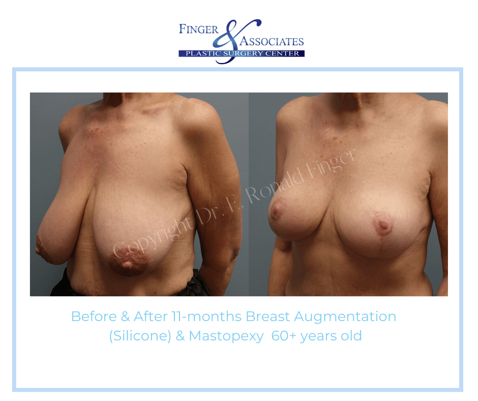 Before and After 11-months Breast Augmentation (Silicone) and Mastopexyy 60+ years old