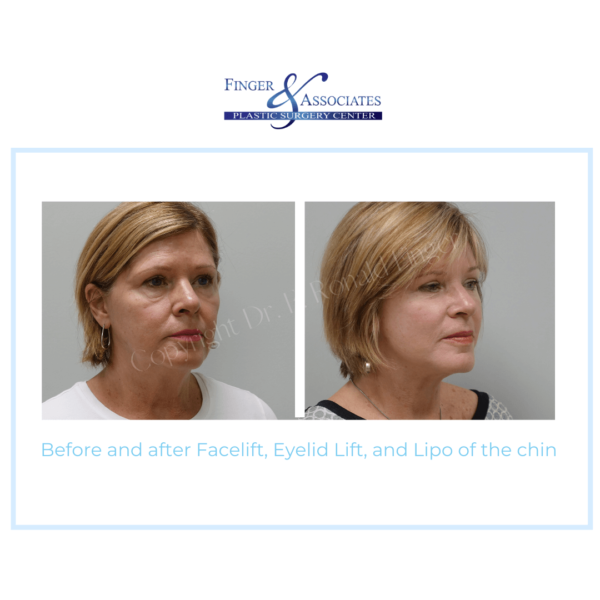 Before and After Facelift, Eyelid Lift and Lipo of the chin