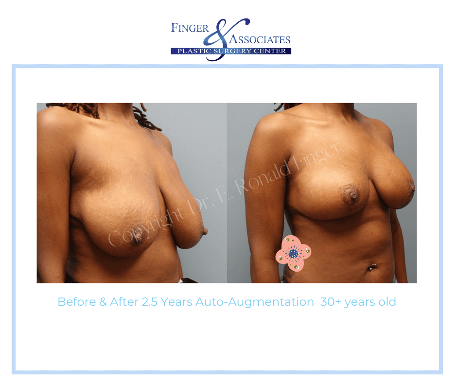 Before and After 2.5 Years Auto-Augmentation 30+ years old