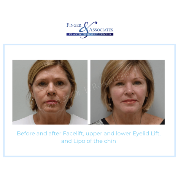 Before and After Facelift, upper and lower Eyelid Lift, and Lipo of the Chin