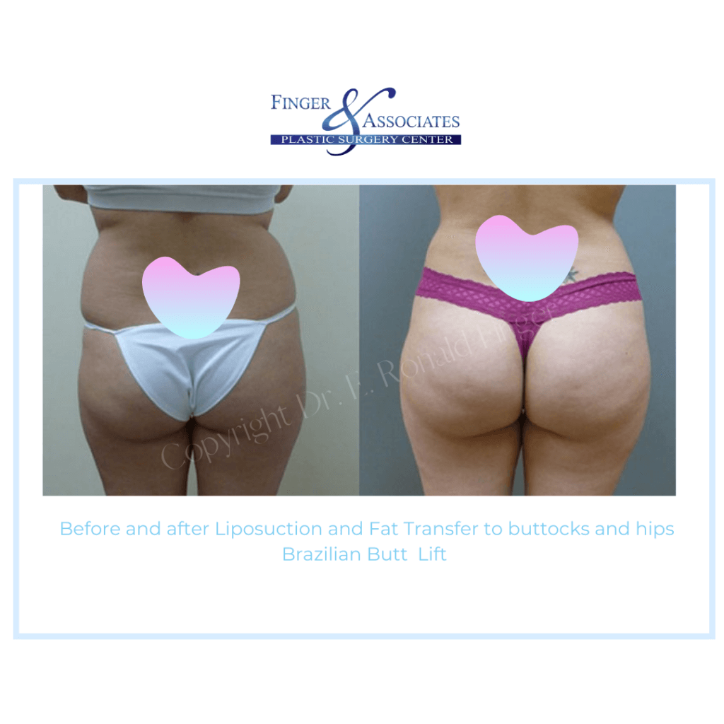 Before and After Liposuction and Fat Transfer to buttocks and hips Brazilian Butt Lift