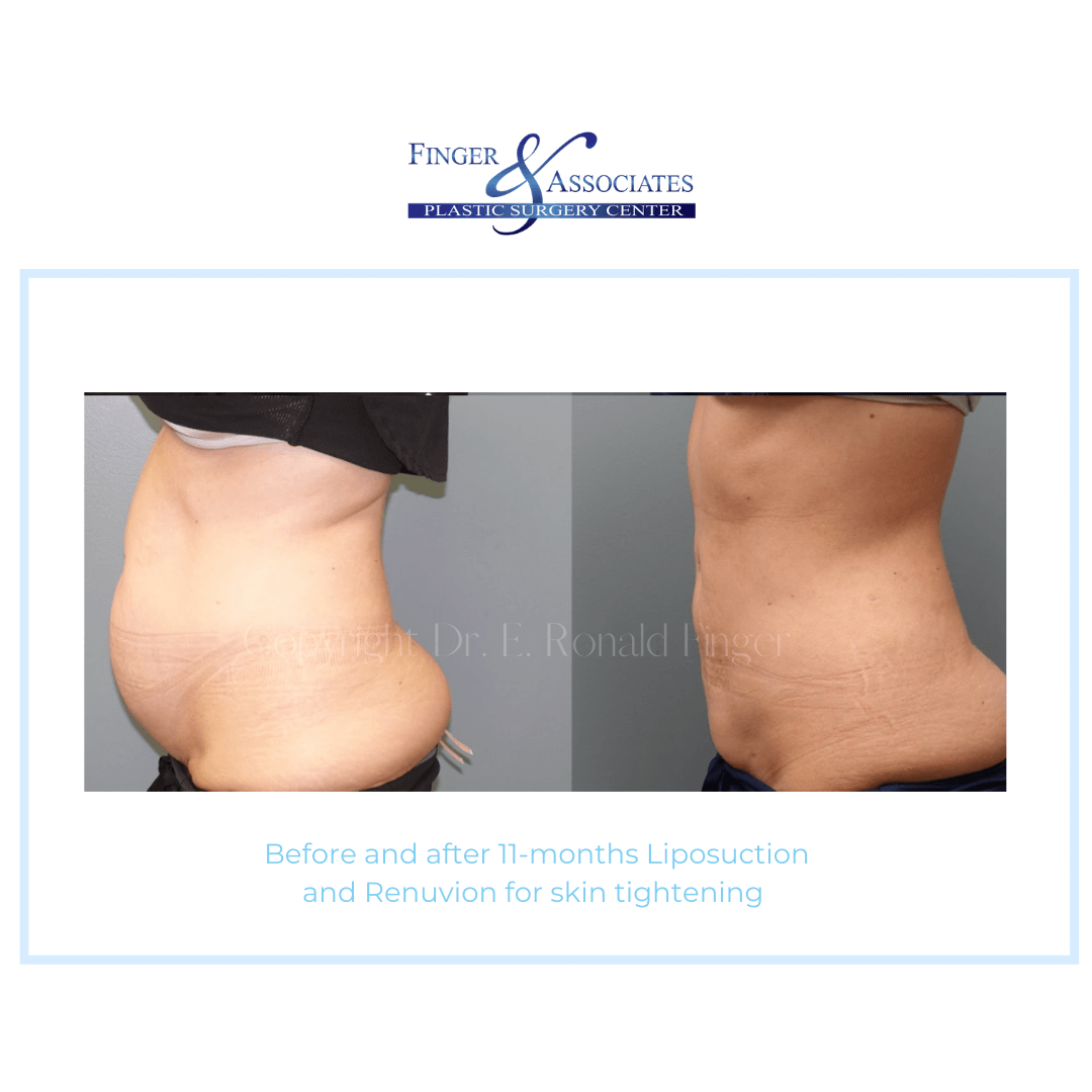 Before and After 11-months Liposuction and Renuvion for Skin Tightening