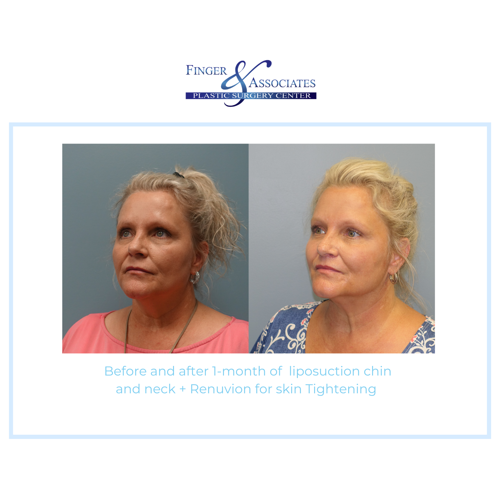 Before and after Renuvion + Lipo by Dr. Finger in Savannah