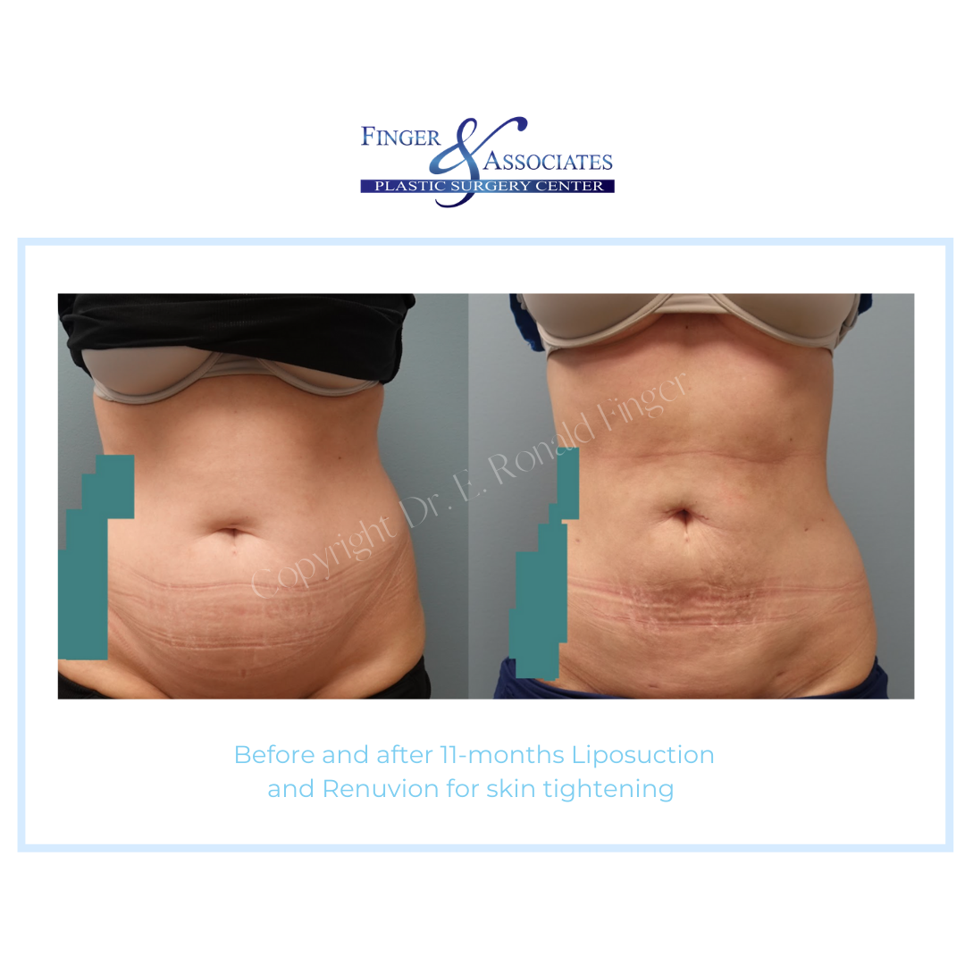 Before and after 11-months Liposuction and Renuvion for skin tightening