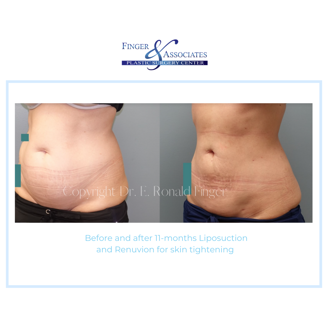 Before and After 11-months Liposuction and Renuvion for skin tightening