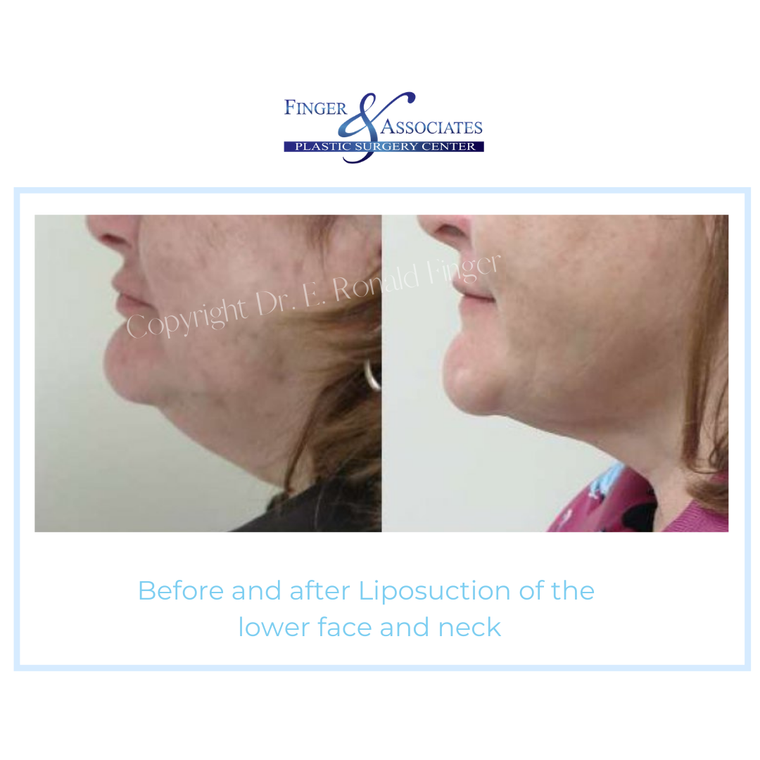Before and After Liposuction of the lower face and neck