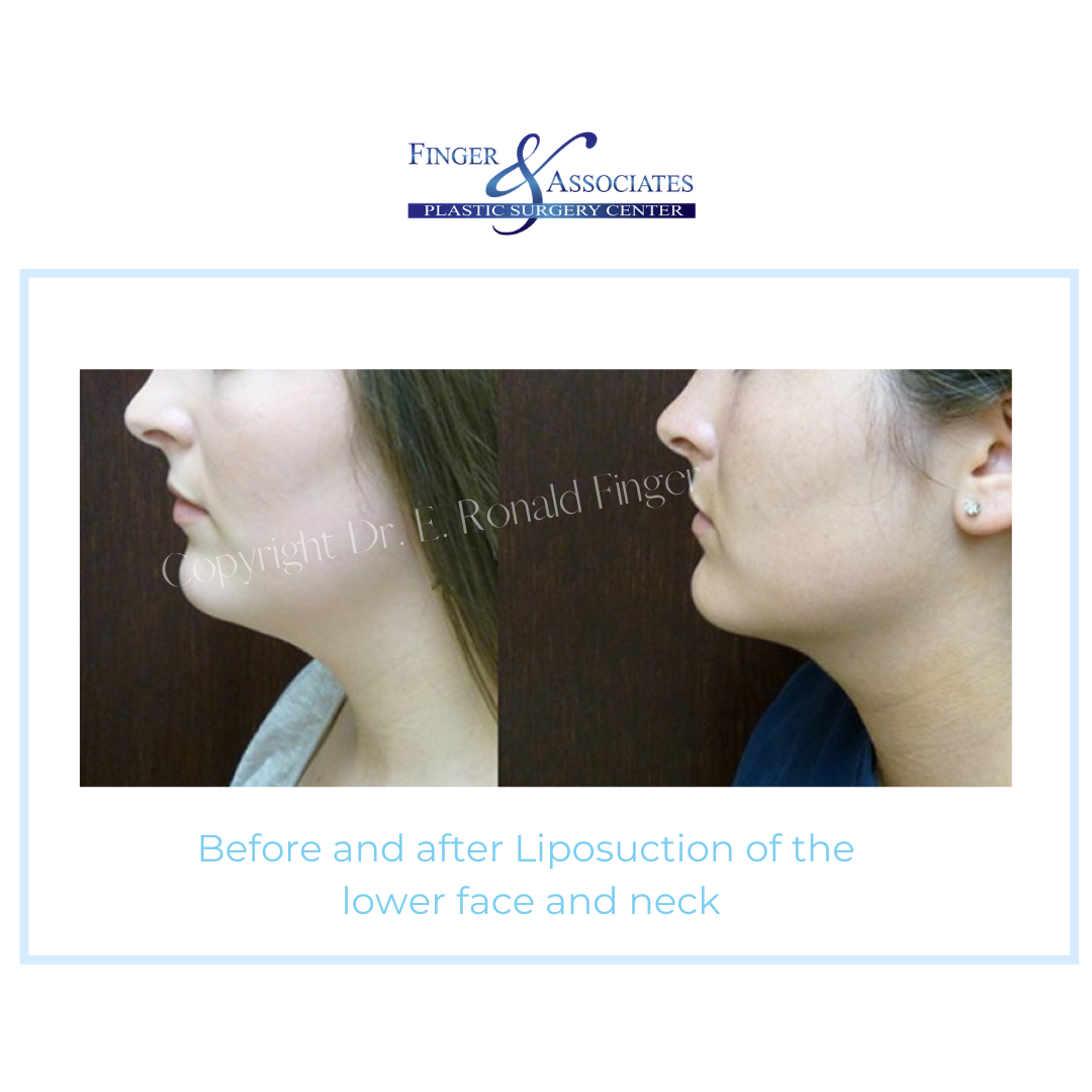 Before and After Liposuction of the lower face and neck