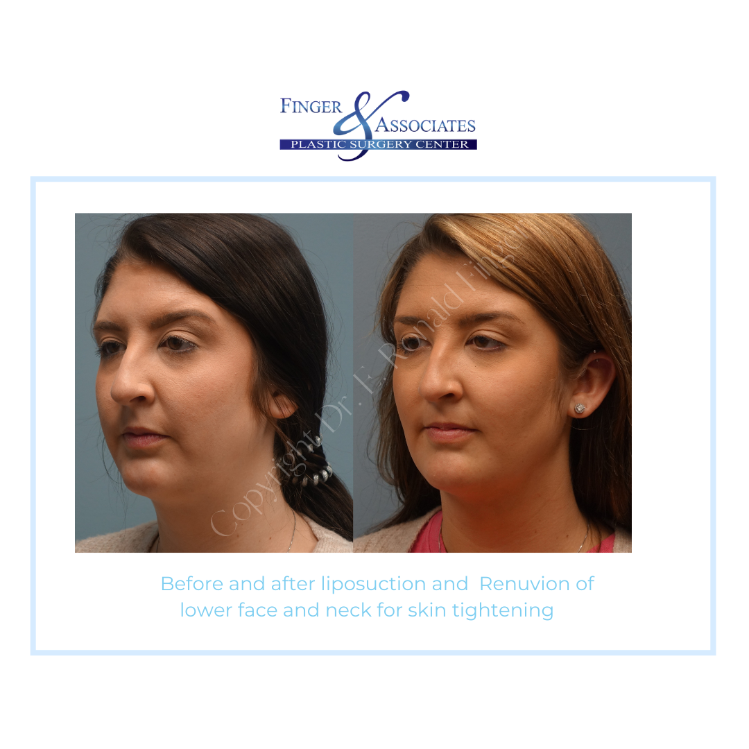 Before and After Liposuction and Renuvion of lower face and neck for Skin Tightening