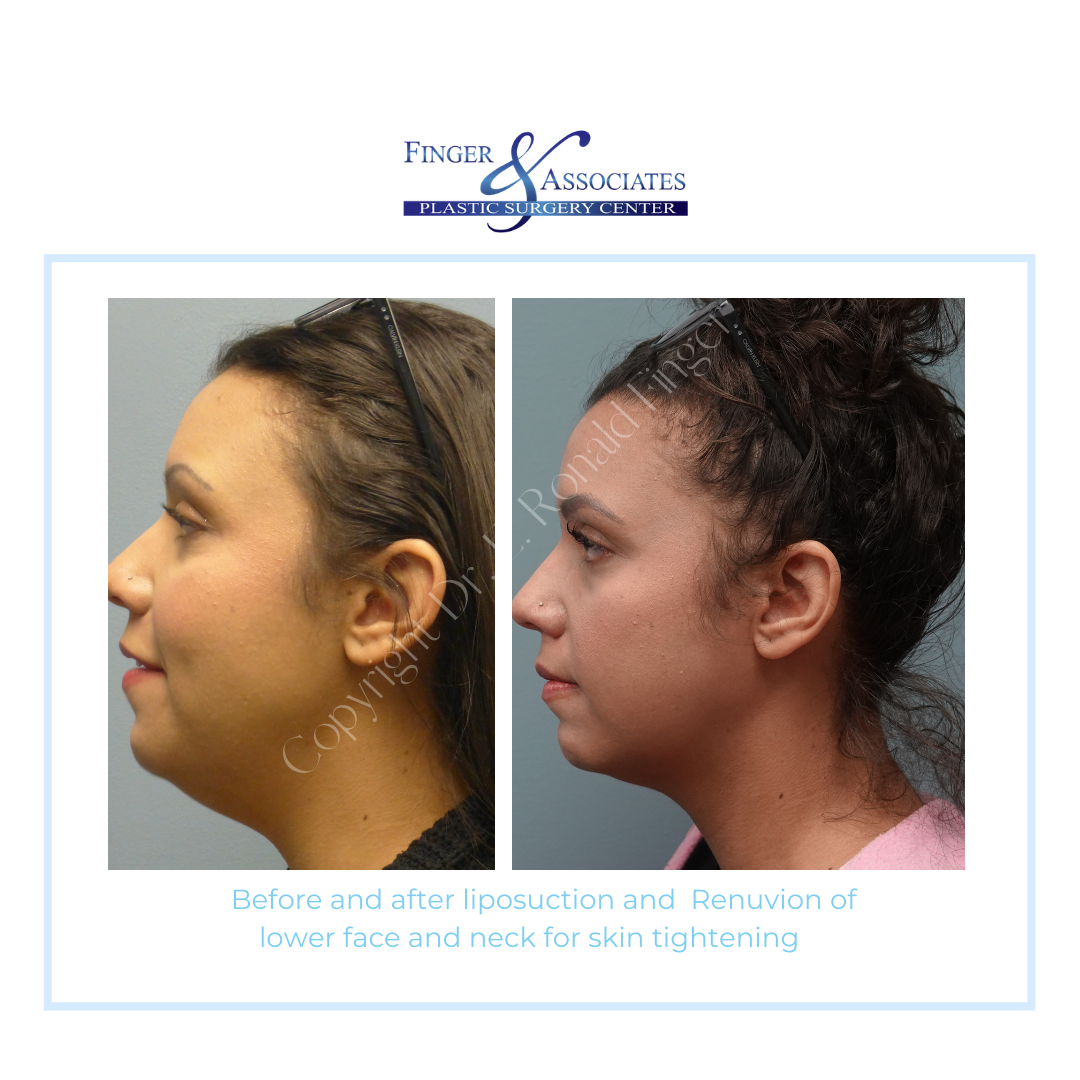 Before and After Liposuction and Renuvion of lower face and neck for Skin Tightening