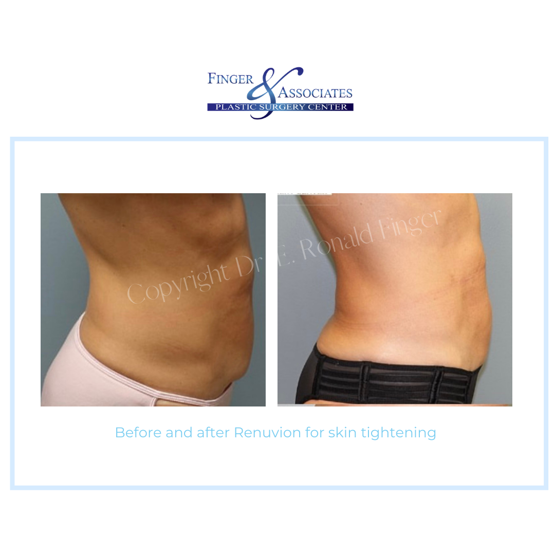 Before and After Renuvion for skin tightening