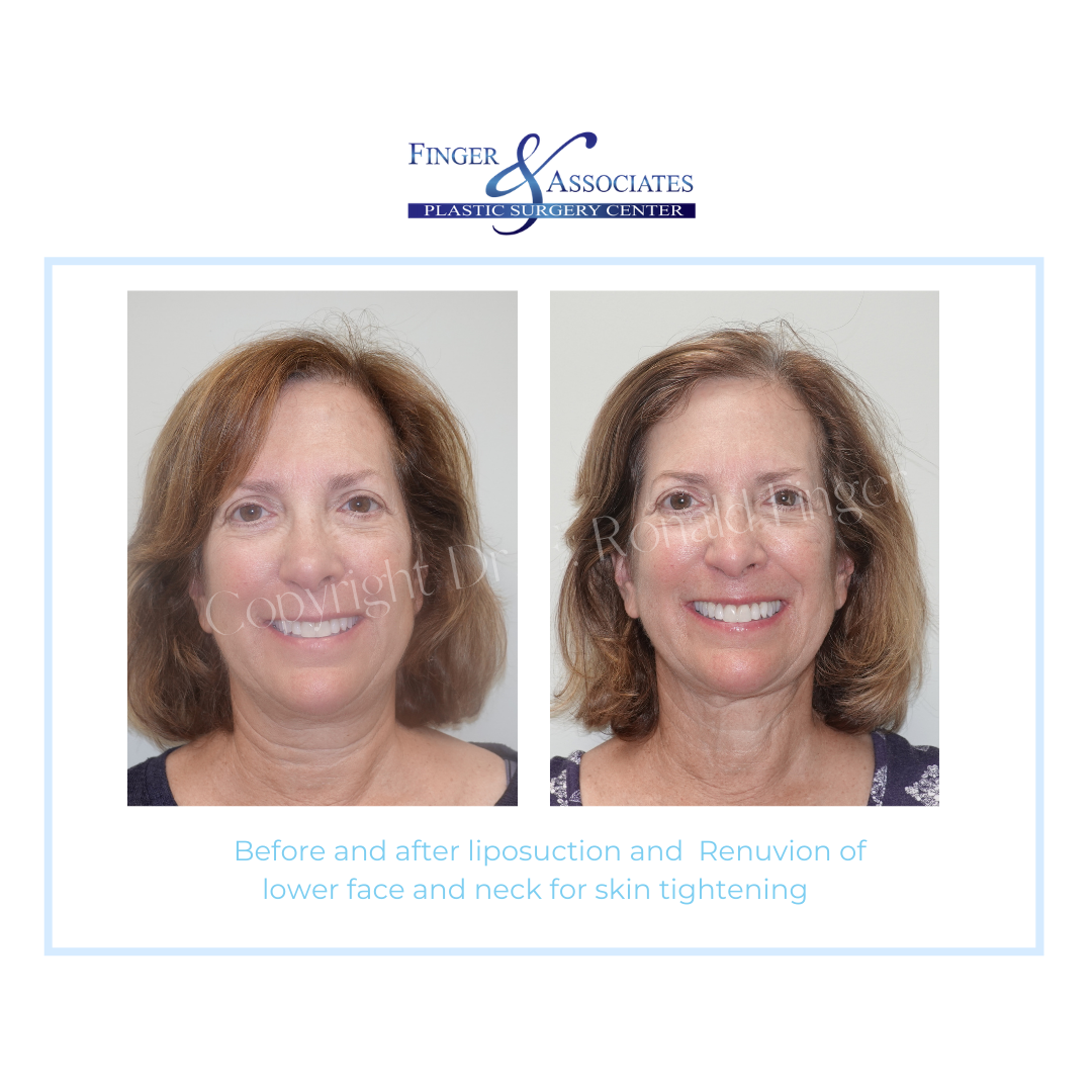 Before and After Liposuction and Renuvion of lower face and neck for skin tightening