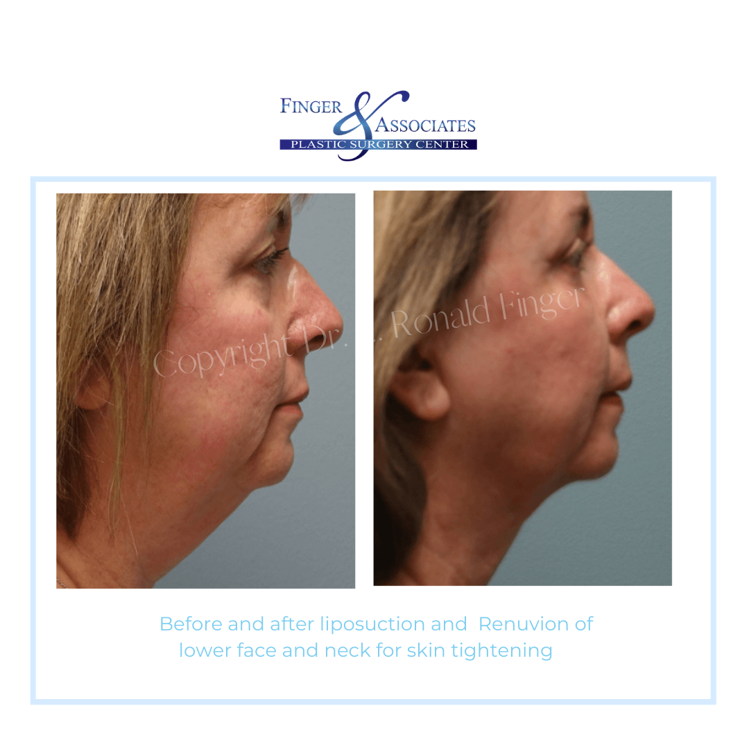 Before and After Liposuction and REnuvion of lower face and neck for skin tightening