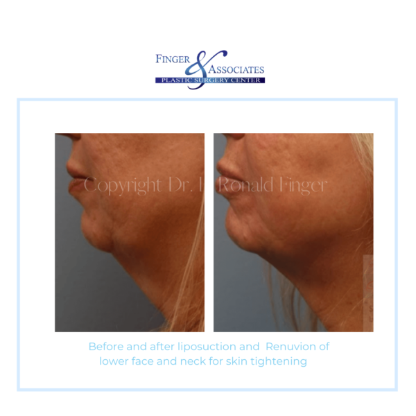 Before and After Liposuction and Renuvion of lower face and neck for Skin Tightening