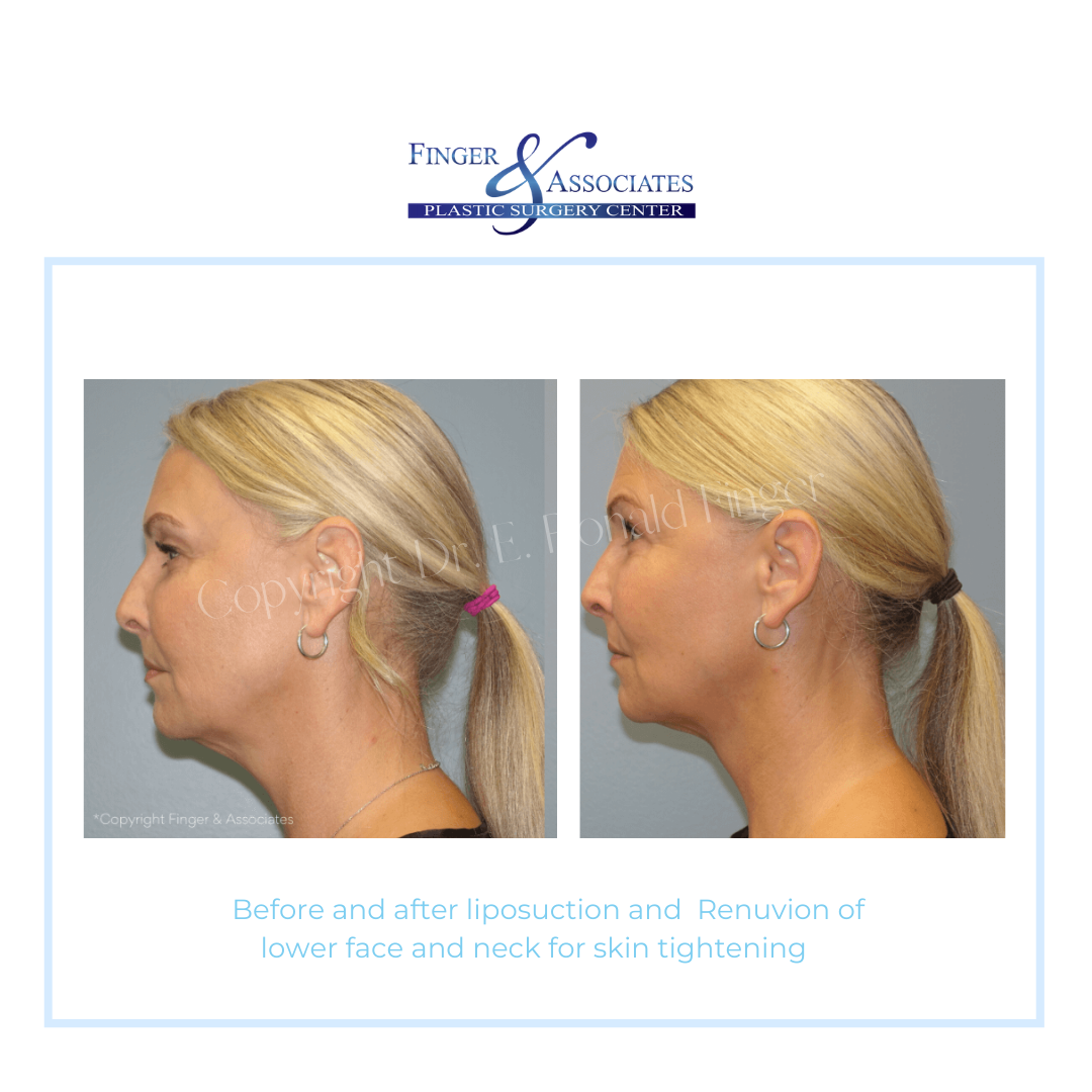 Before and After Liposuction and Renuvion of lower face and neck for Skin Tightening