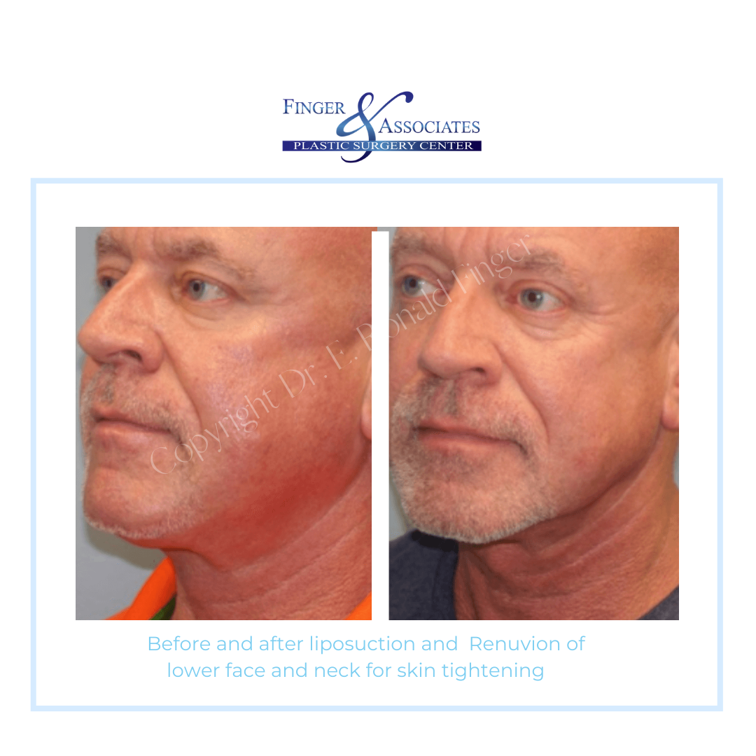 Before and After Liposuction and Renuvion of lower face and neck for Skin Tightening