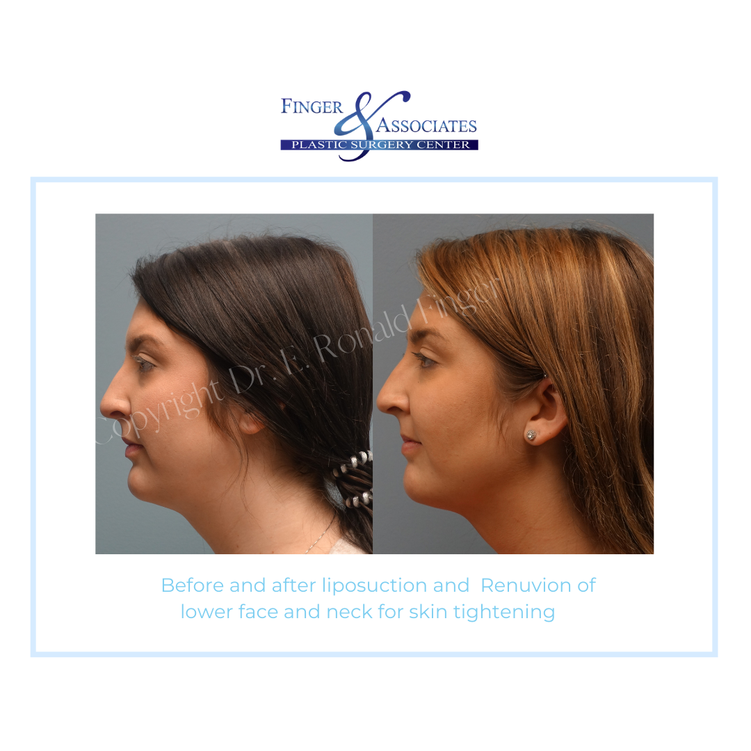 Before and After Liposuction and Renuvion of lower face and neck for Skin Tightening