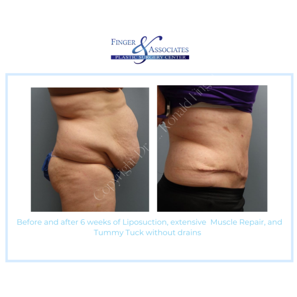 Before and After 6 weeks of Liposuction, extensive Muscle Repair, and Tummy Tuck without drains
