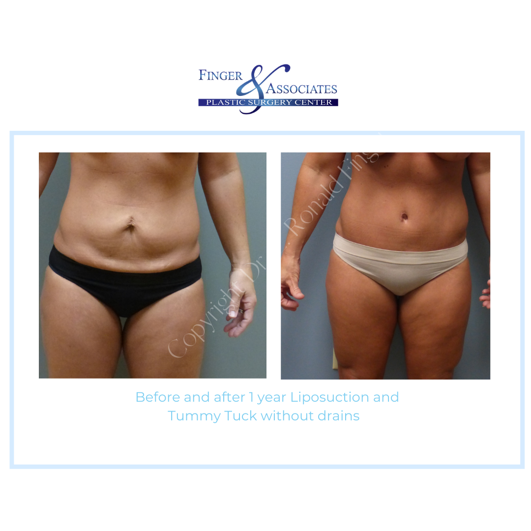 Before and After 1 year Liposuction and Tummy Tuck without drains