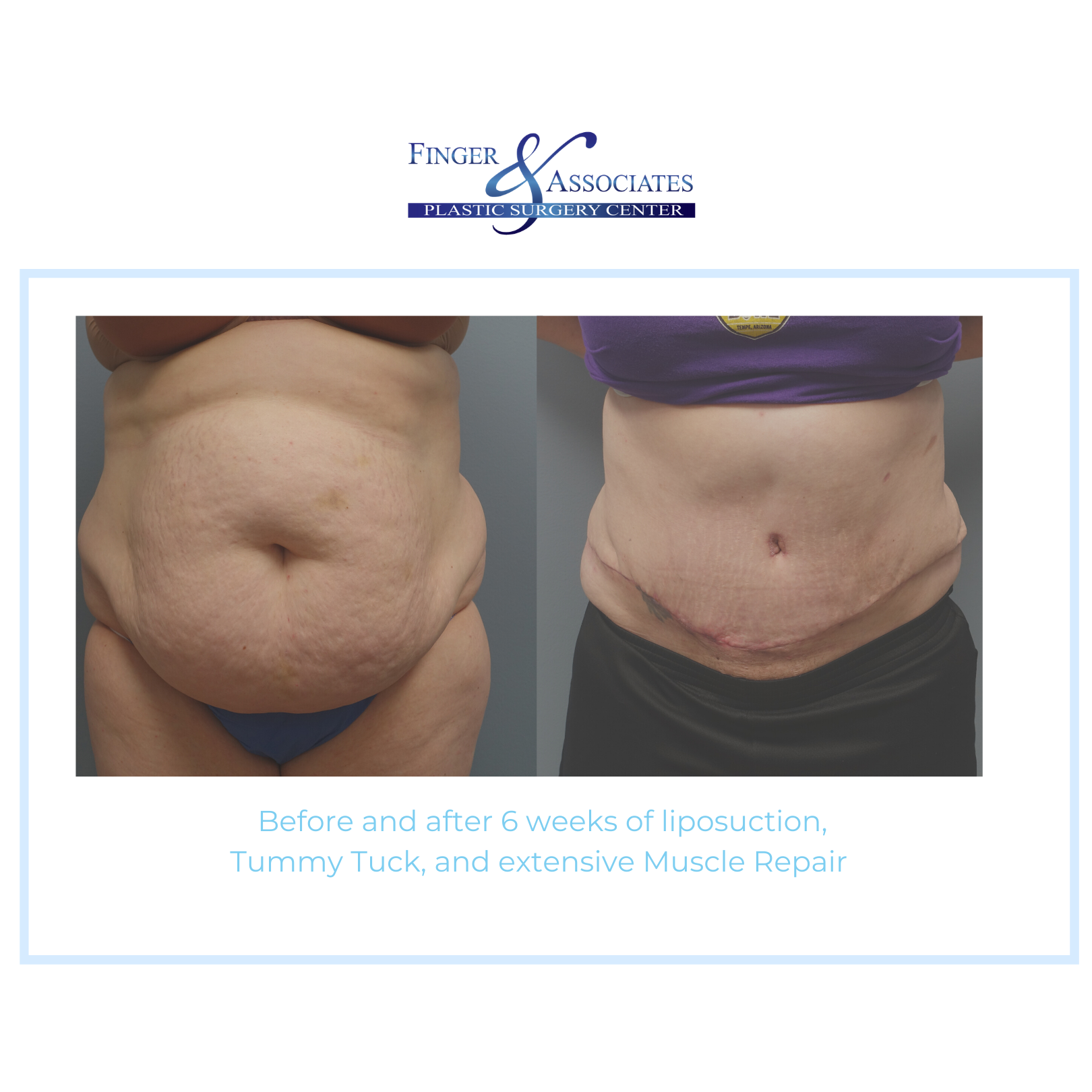 Tummy Tuck and lipo + Muscle Repair