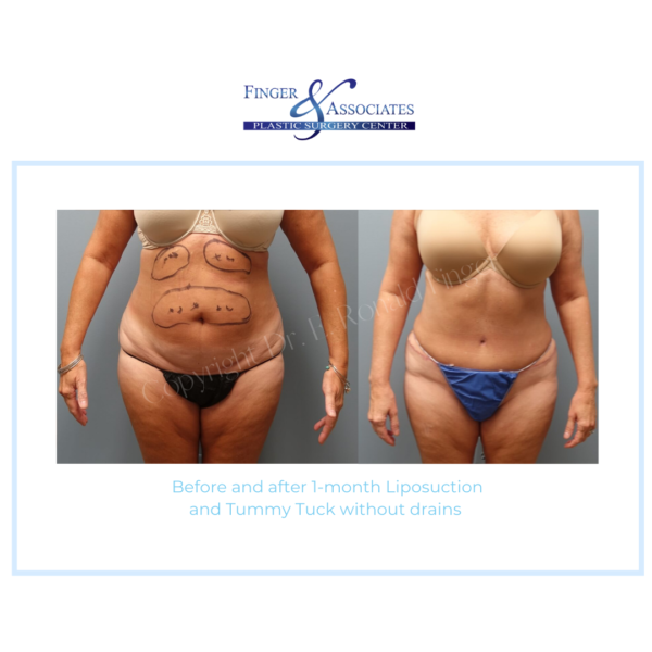 Before and after 1-month Liposuction and Tummy Tuck without drains