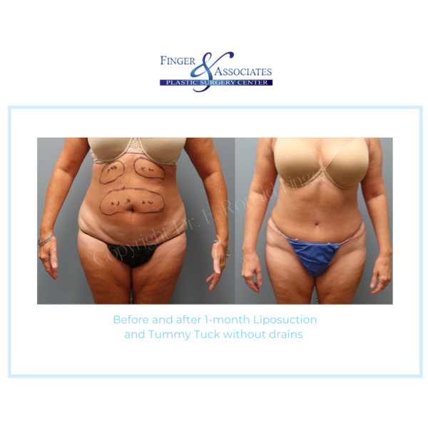Before and after 1-month Liposuction and Tummy Tuck without drains Before and after 1-month Liposuction and Tummy Tuck without drains