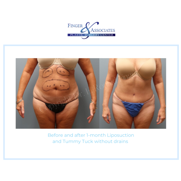 1 Plastic Surgeon Dr. Finger Offers The No Drain Tummy Tuck