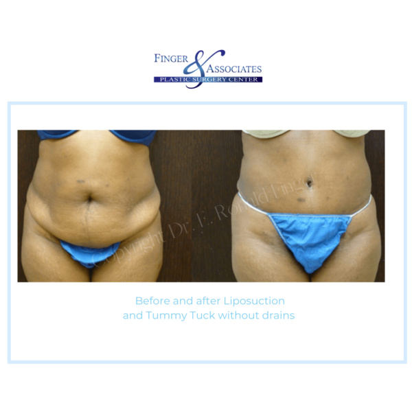 Before and After Liposuction and Tummy Tuck without drains