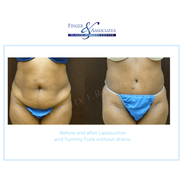 1 Plastic Surgeon Dr. Finger Offers The No Drain Tummy Tuck