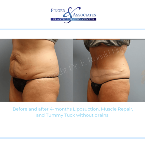 Before and after 4-months Liposuction, Muscle Repair, and Tummy Tuck without drains Before and after 4-months Liposuction, Muscle Repair, and Tummy Tuck without drains