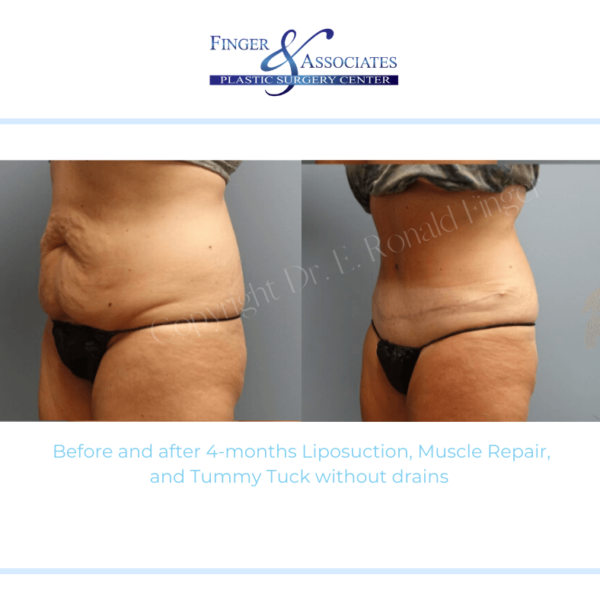 Before and after 4-months Liposuction, Muscle Repair, and Tummy Tuck without drains