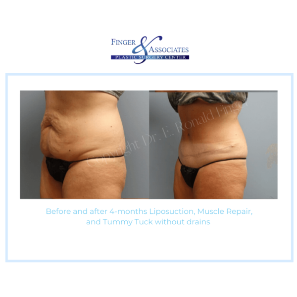 tummy tuck without drains (7)