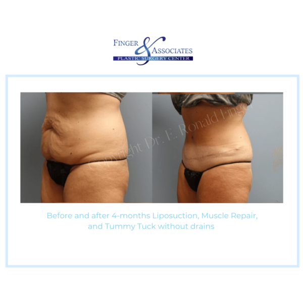 tummy tuck without drains (7) tummy tuck without drains (7)