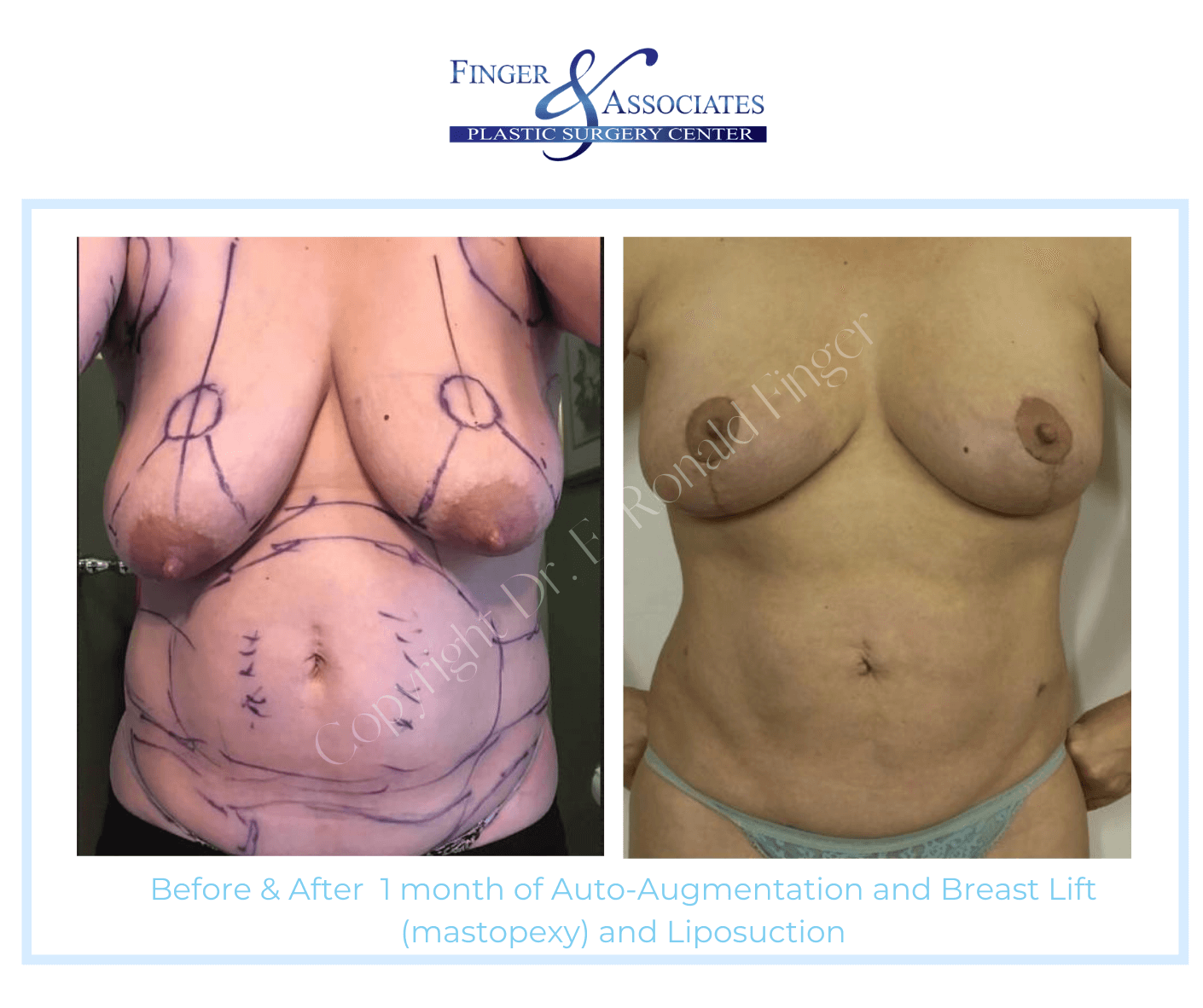 BEFORE AND AFTER 1-MONTH AUTO-AUGMENTATION AND LIPOSUCTION