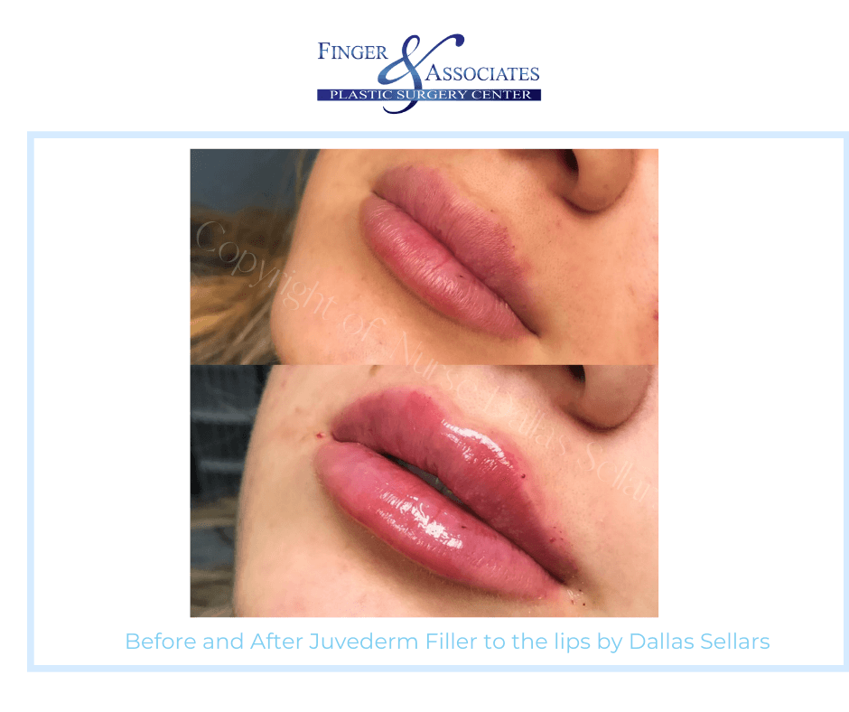 _Before and After Juvederm Filler to the lips by Nurse Dallas Sellars - Finger & Associates