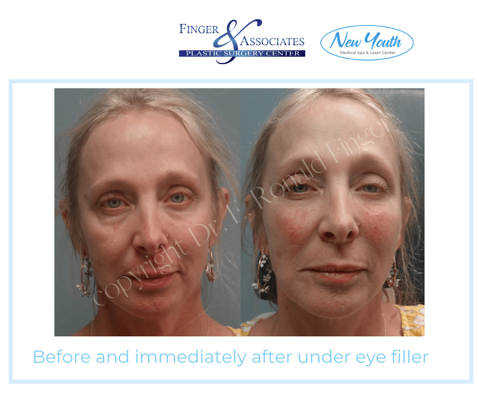 Before and immediately after under eye filler