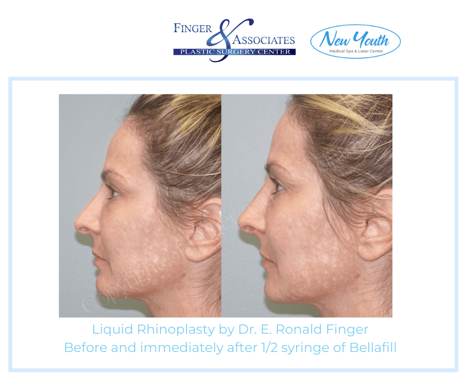 Liquid Rhinoplasty by Dr. E. Ronald Finger Before and immediately after 1/2 syringe of Bellafill