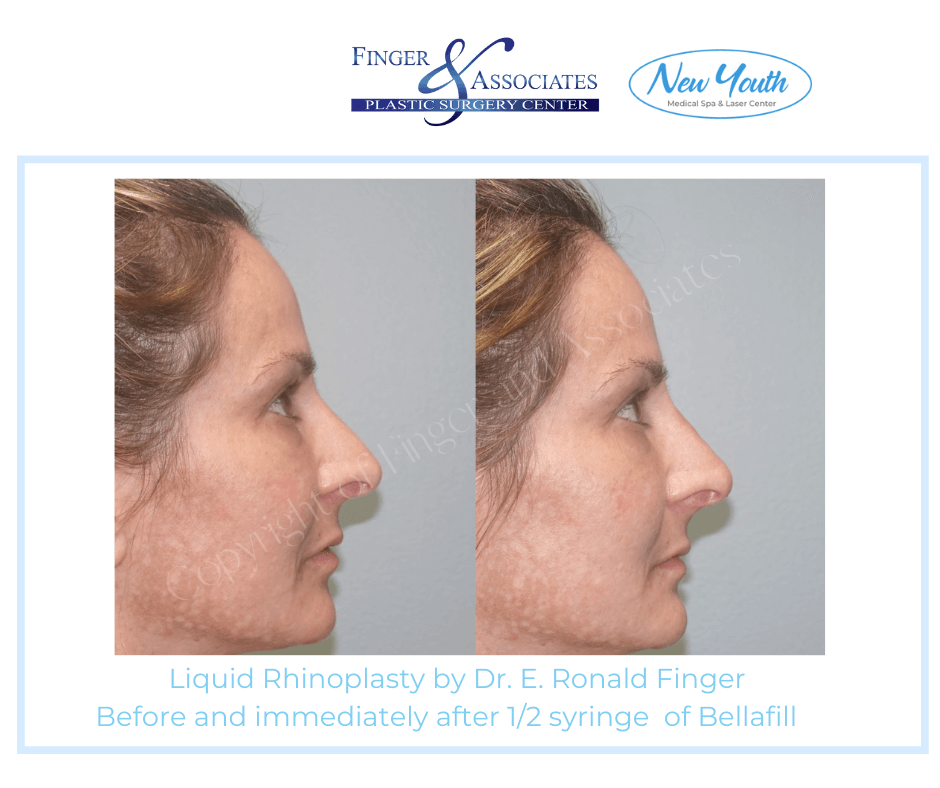 Liquid Rhinoplasty by Dr. E. Ronald Finger Before and immediately after 1/2 syringe of Bellafill